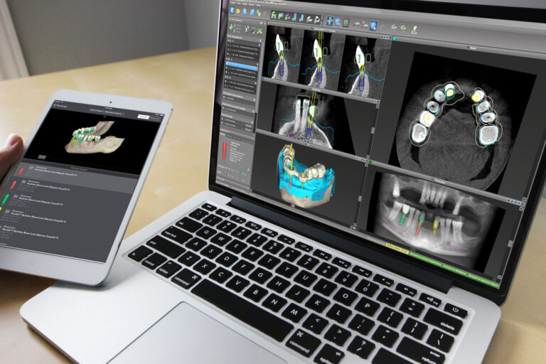 Planificación digital del tratamiento con CoDiagnostiX